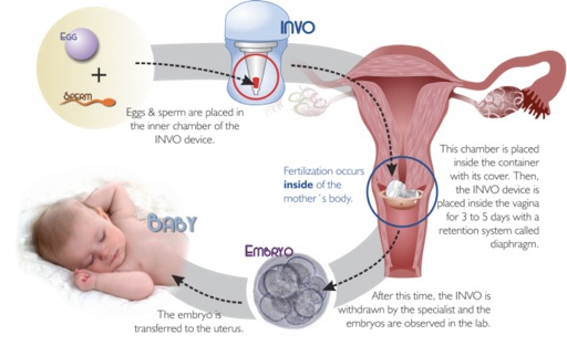 Invocell Virginia Center For Reproductive Medicine Virginia Center For Reproductive Medicine